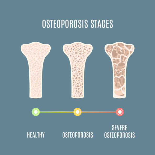 the best Osteoporosis calcium supplement